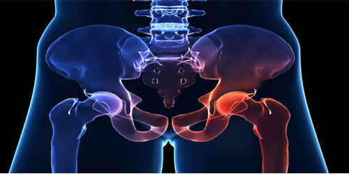 Hip Arthroscopy