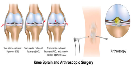 Arthroscopic Surgery