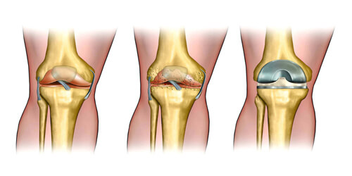 Knee Replacement Surgery