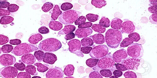Acute Lymphoblastic Leukemia