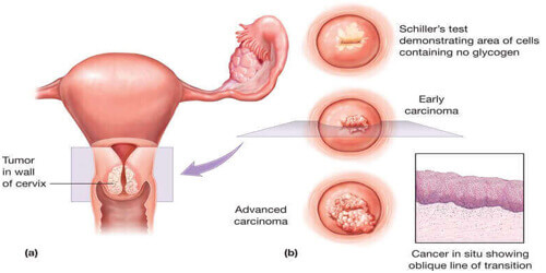 Cervical Cancer 