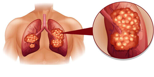 LUNG CANCER