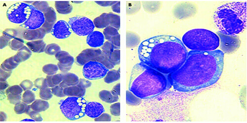 Acute Myeloid Leukemia