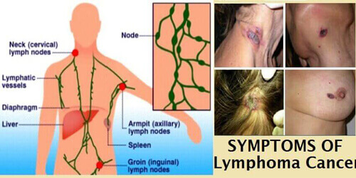 Lymphoma