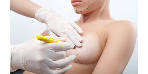 Breast surgery
