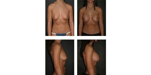 Breast augmentation