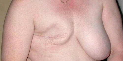 Mastectomy