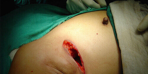 Breast-conserving surgery
