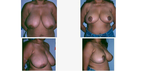 Breast reduction surgery