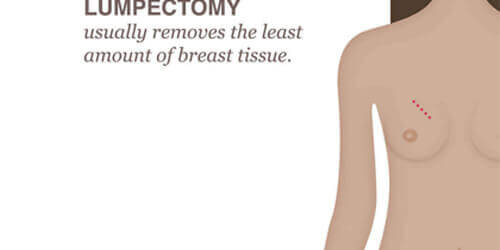 Lumpectomy