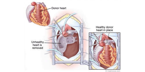Heart Transplant
