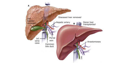 Liver Transplantation