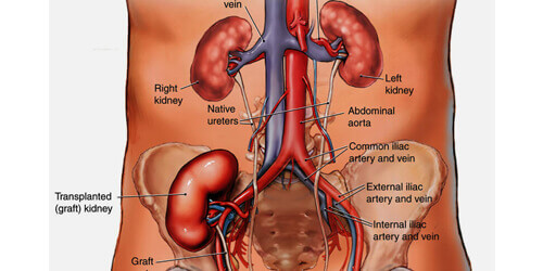 Kidney Transplant
