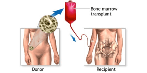 Bone Marrow Transplantation