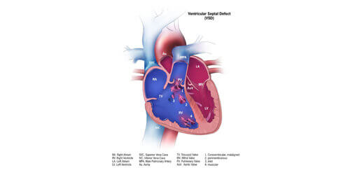 Atrial/Ventricular Septal Defects - Device Closure