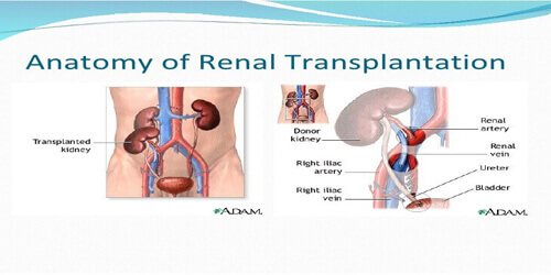Renal Transplant