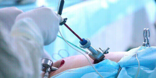 Laparoscopic 