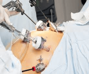 Minimal Access Surgery