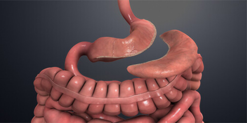 Sleeve Gastroectomy