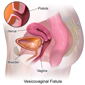 Treatment for Vesicovaginal and Rectoviginal Fistula