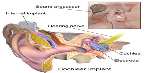 Cochlear Implantation Package