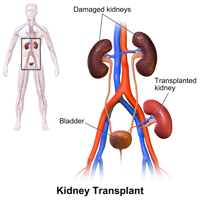 Kidney Transplantion Surgery